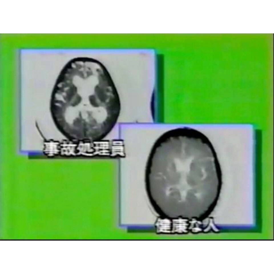 放射能と知能低下
　
放射能は脳の障害が起こることが分かっています。
有名なチェルノブイリ事故の被曝者を診察してきた医師の記述によると、発癌も被曝障害の最大の障害ではなく、最大の障害は知能低下と性格崩...