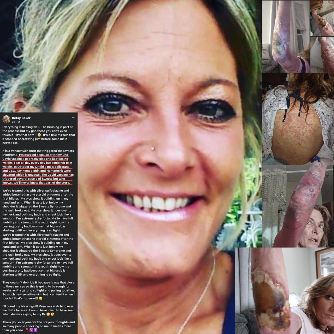 She got really sick after the Covid vaccine💉. She has "Sweets Syndrome."