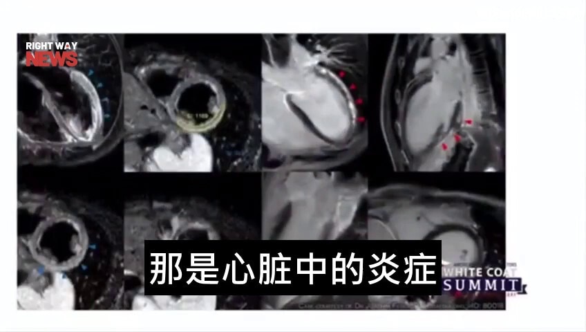 不要打疫苗，疫苗副作用会导致心肌炎、心包炎、心梗、脑梗。为了家人和自己请拒绝注射疫苗！