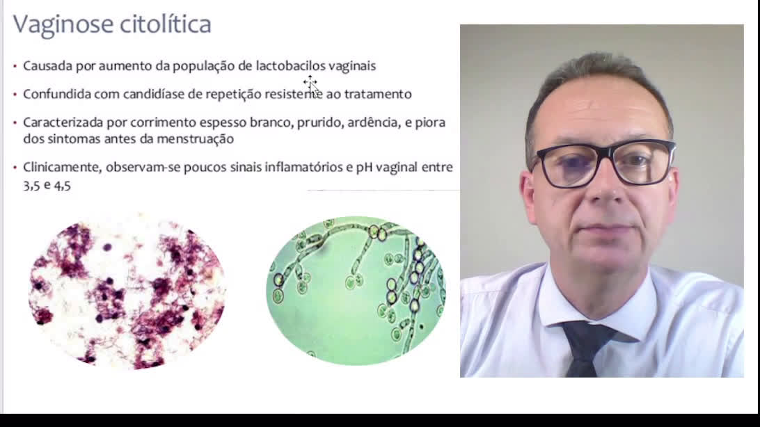 Vaginose citolítica 
É uma causa mais rara de vaginite, que causa sintomas muito semelhantes aos da ...