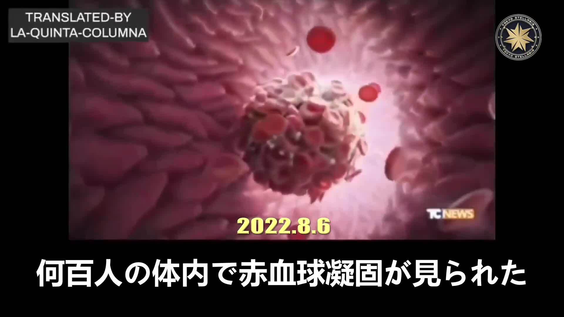 接種者の 80% に赤血球汚染と外因性物質

生物学者フランコ・ジョヴァンニ医師: ワクチン接種者の80％は体内で構造的変化が起こった。血小板凝集、グラフェン様の外因性物質が見られ、そして、難治性頭痛、顕著な脱力感、脳卒中、心臓発作、心筋炎などの深刻な臨床症状を伴う
#赤血球凝固#グラフェン#血栓