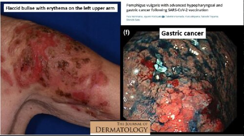 courtesy Telegram's @DrJohnB:

July 2022:  Pemphigus vulgaris with advanced hypopharyngeal and gastric cancer (!) following SARS-CoV-2 vaccination [BNT162b2]:

https://onlinelibrary.wiley.com/doi/10.1111/1346-8138.16539

 #Pfizer #mRNA #covid19vaccines @DrNaomiRWolf @mercola @DrEddyMD @DailyExposeGB @EpochTimes @LifeSiteNews