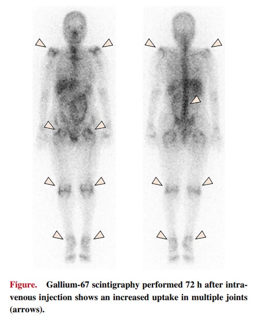 Polymyalgia Rheumatica Following COVID-19 Vaccination:
A Case Report

"We herein report a patient wh...