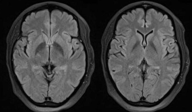 New-onset refractory status epilepticus following the ChAdOx1 nCoV-19 vaccine

"Healthcare providers should be aware of the possibility of post-vaccination