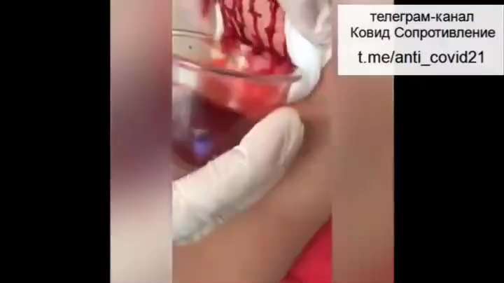 OMG..Watch this shit!! Removing the poison from the vaccine!😳😳 

