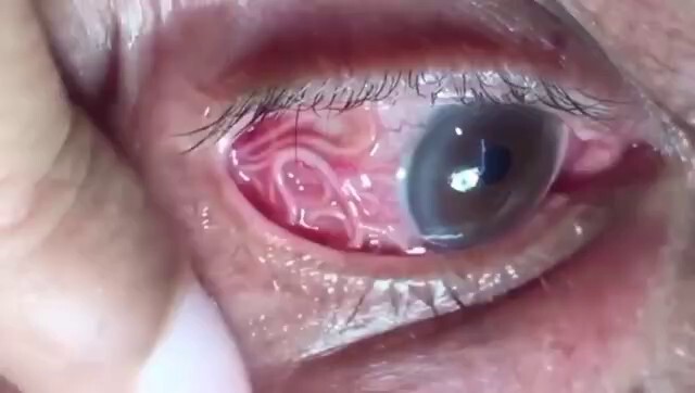 🚨💉😱!!
白目しばりVer.😱ｷﾞｪｪｪ!!!
これもワクチン接種後って💧

⬇黒目Ver.
https://gettr.com/post/peuz5l5434