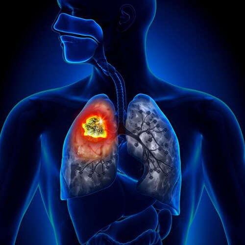 https://www.ncbi.nlm.nih.gov/pmc/articles/PMC8858430/ Interstitial lung disease after receiving the ...
