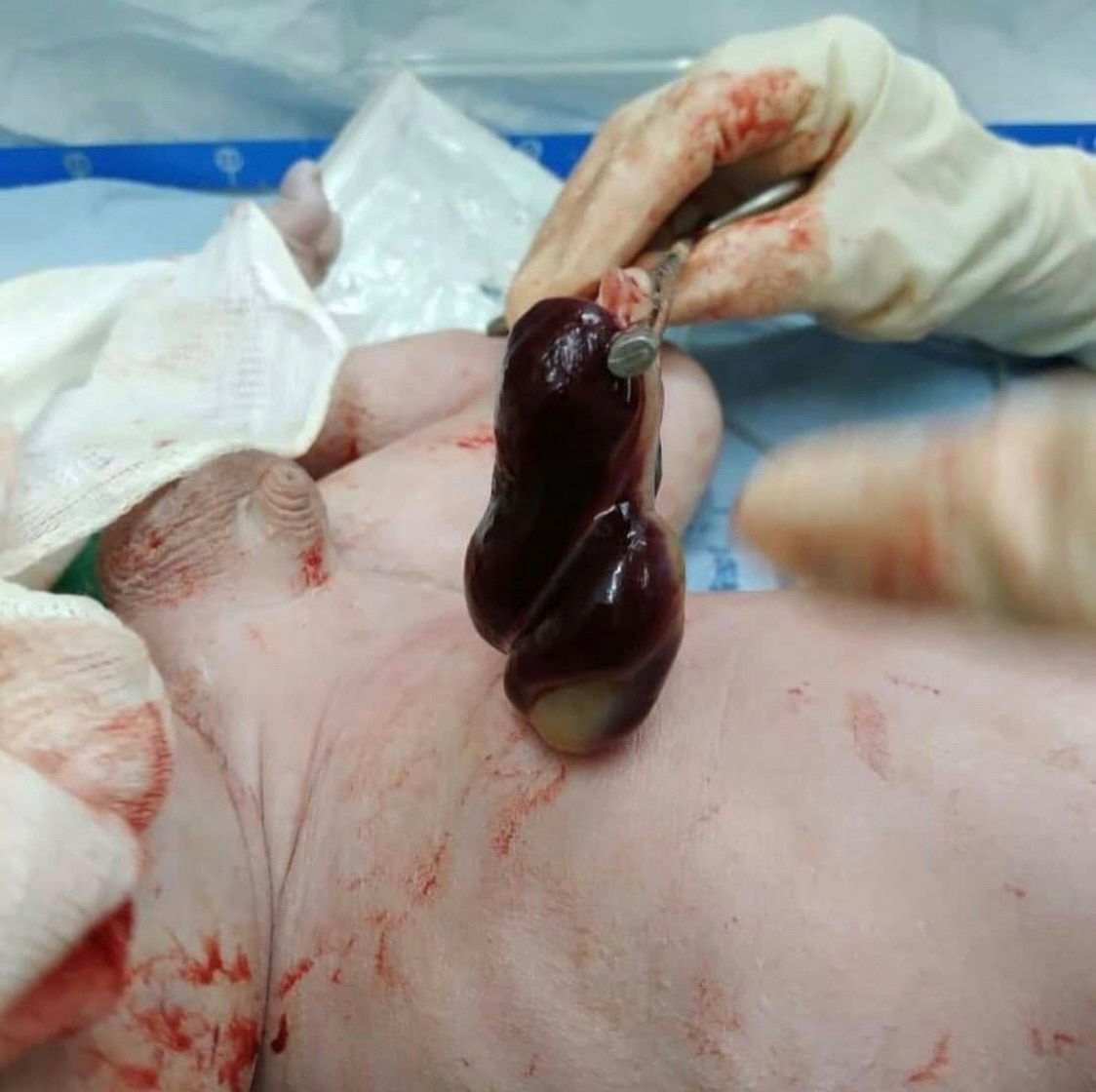 ❅ Babies Murdered by Vaccines ❅ 

💉👶☠️⚰️

A newborn, with placental thrombosis at the umbilical cord, died even before working on life.

The mother was vaccinated with two doses of Covid-19 vaccine and is still in intensive care.

Thousands of cases like this are currently happening around the world.Babies are born dead or are victims of false layers caused by Pfizer, Astrazeneca, Moderna and Johnson vaccines.

Politicians, pharmaceutical companies and the media kill this generation and the next one without remorse or pity.