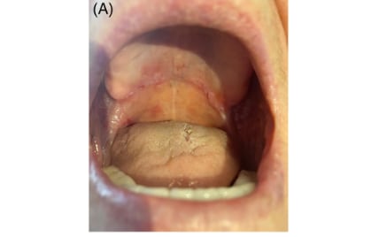 Pemphigus vulgaris after SARS-CoV-2 vaccination: A case with new-onset and two cases with severe aggravation

"People worldwide are currently vaccinated with several SARS-CoV-2 vaccines which may be associated with increased number of aggravated or triggered autoimmune bullous diseases..."

https://onlinelibrary.wiley.com/doi/10.1111/dth.15396 

#CoronaVac #Pfizer #mRNA @DrNaomiRWolf @mercola @DrEddyMD @DailyExposeGB @EpochTimes @LifeSiteNews