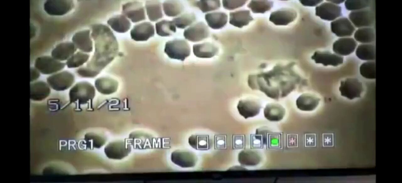 接種C19疫苗後的血液變化🩸專家用電子顯微鏡⋯給你看清楚👀Blood changes after the C19 vaccination...with a microscope...for you...