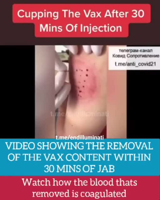 ワクチン💉ジョブから30分後の血液の状況…!!
生レバ??😱💧