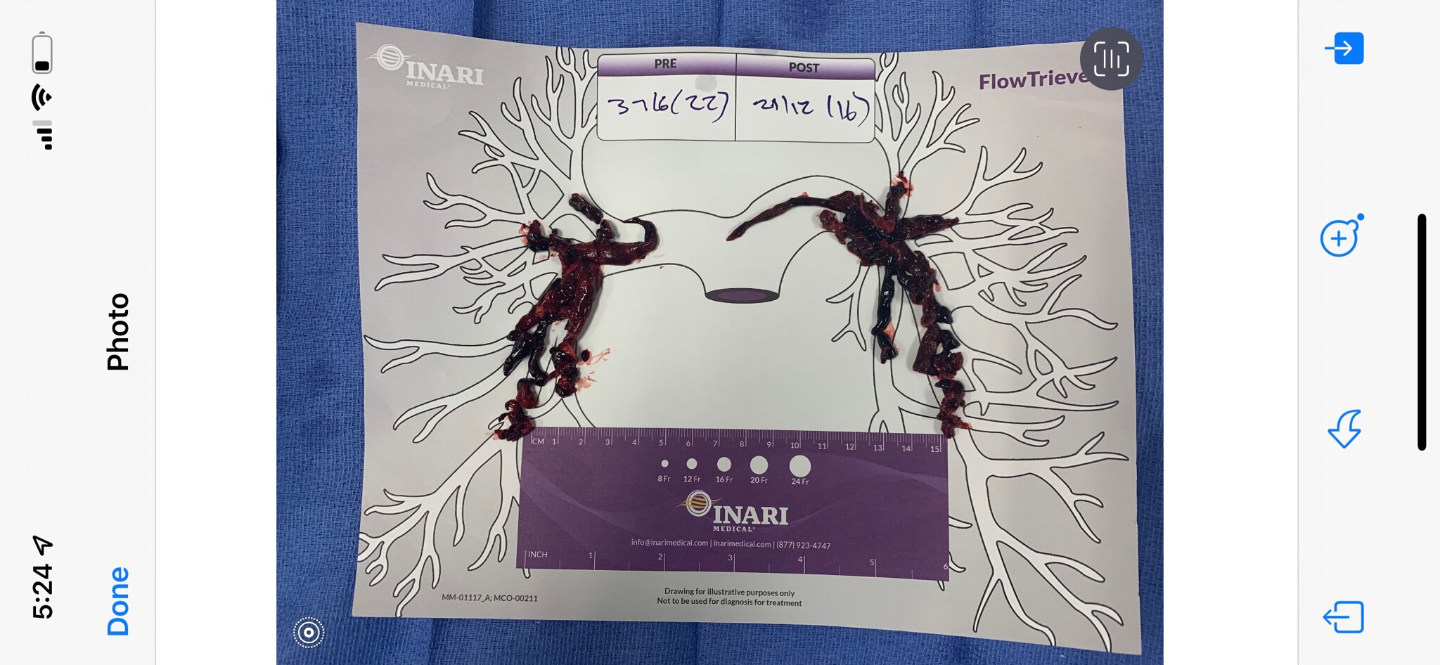 @DrNaomiRWolf my girlfriend sent me a post you reposted regarding a pulmonary embolism in a 70yr old who got the jab.
Below are the clots found in the lungs of my 50yr old friend. They said they were from long term estrogen use from her birth control and her lower limb broken leg (she was currently in a cast at the time.) Also had a clot where her broken bone was located. She is on blood thinners for a year.
Covid jab and boosted at least once (we dont talk about the jab bc I know she feels very differently from how I feel.) 