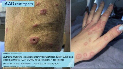 courtesy Telegram's @DrJohnB:

2022:  Erythema multiforme reactions after Pfizer/BioNTech (BNT162b2) and Moderna (mRNA-1273) COVID-19 vaccination: A case series

"With widespread COVID-19 vaccination under way, more information will emerge about the relationship of erythema multiforme to COVID-19 vaccination."

https://www.jaadcasereports.org/article/S2352-5126(21)00902-4/fulltext

#Pfizer #Moderna #mRNA #covid19vaccines @DrNaomiRWolf @mercola @DrEddyMD @DailyExposeGB @EpochTimes @LifeSiteNews