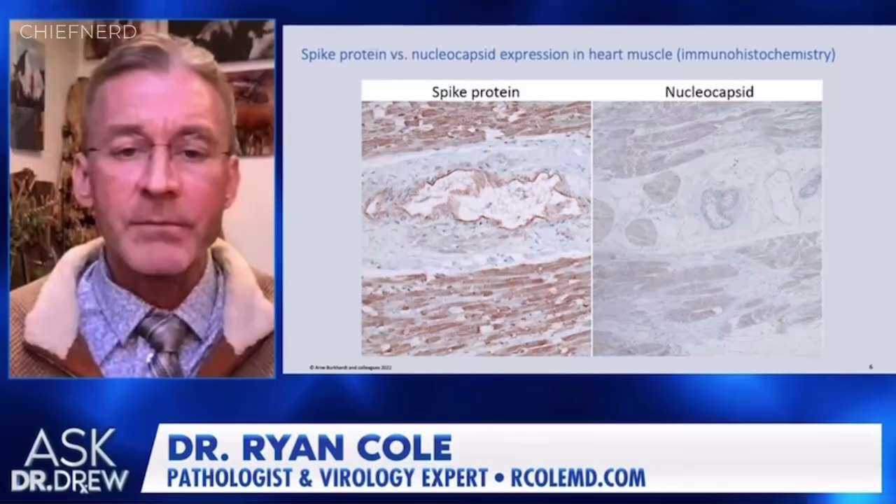 🚨 Pathologist Dr. Ryan Cole Shares New ‘Highly Concerning’ Autopsy Results Showing Vaccine Spike Pr...