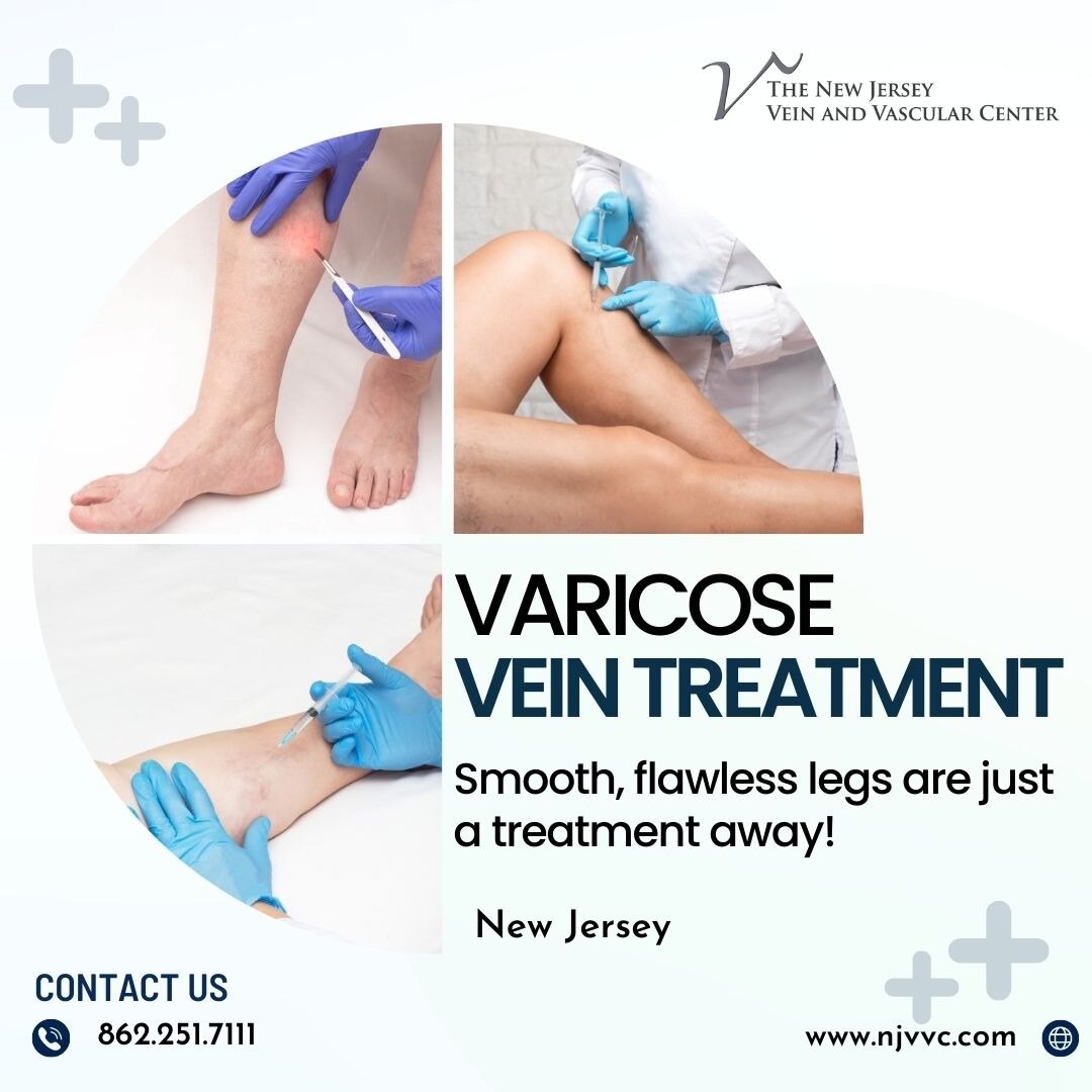 Varicose veins can cause discomfort and affect your quality of life. If you're seeking effective varicose vein treatment, finding the right doctor is crucial. At NJVVC, you will get exceptional results from highly skilled and experienced vascular specialists. Book an appointment now.
Visit: https://njvvc.com/vein-conditions-symptoms/varicose-veins/