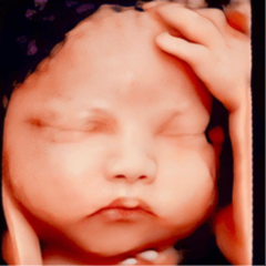 Siêu âm 4D là kỹ thuật chẩn đoán hình ảnh giúp mẹ bầu quan sát trực tiếp hình ảnh và hoạt động của thai nhi trong bụng m...