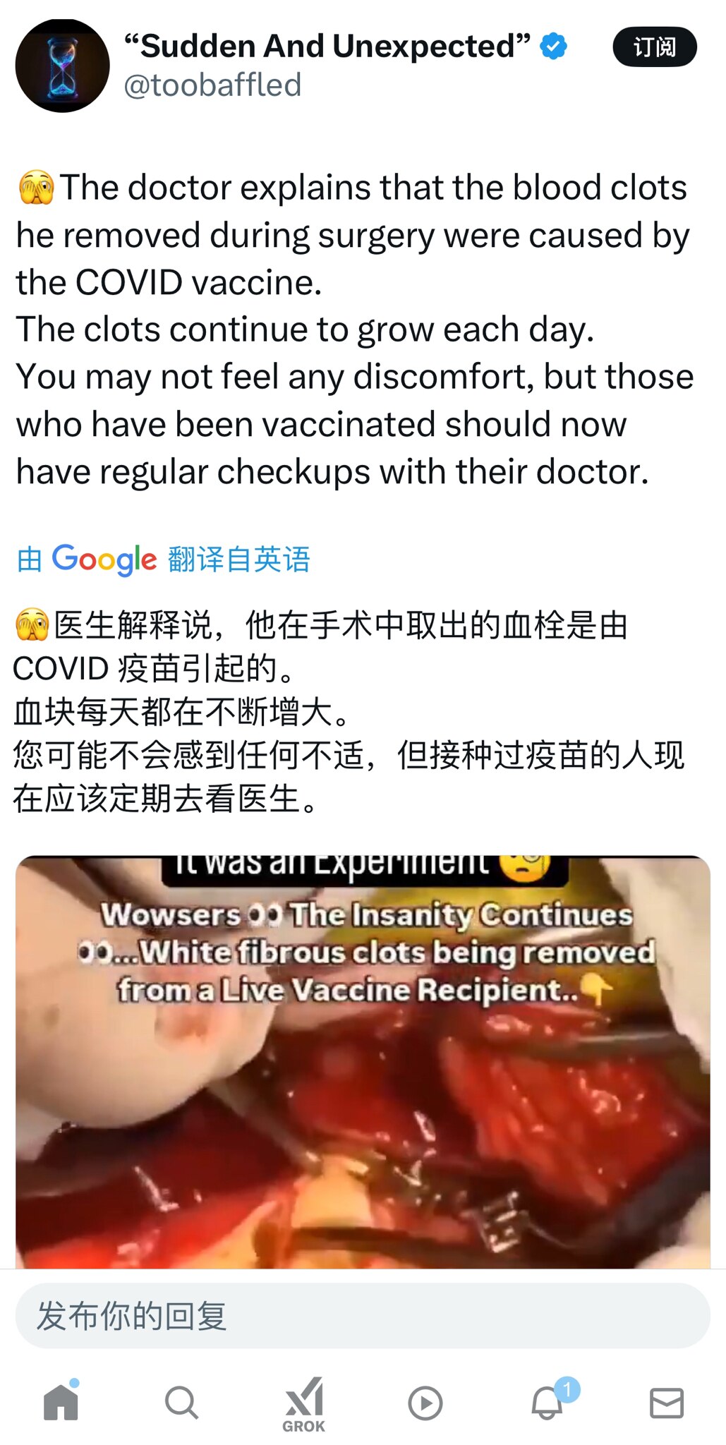 🫣医生解释说，他在手术中取出的血栓是由 COVID 疫苗引起的。
血块每天都在不断增大。
您可能不会感到任何不适，但接种过疫苗的人现在应该定期去看医生。