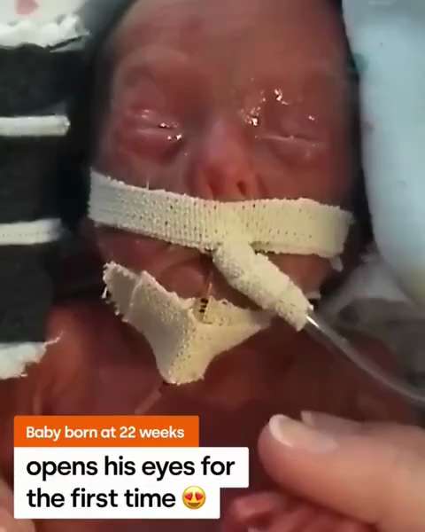 This is little Benson, born prematurely at 22 weeks. 

Where's the clump of cells they're talking ab...