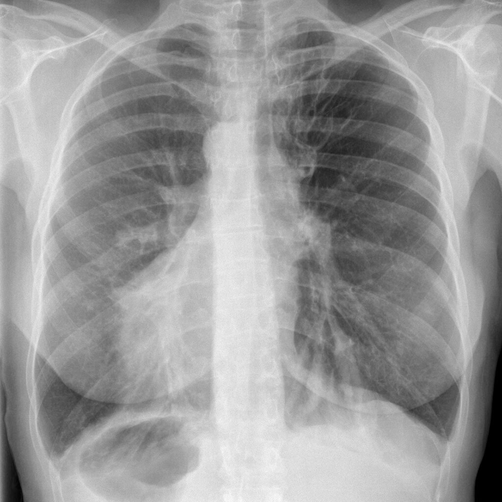 Primary Ciliary Dyskinesia Market is Estimated to Witness High Growth Owing to Rising Demand for Tar...