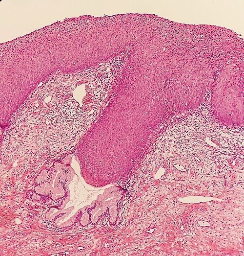 Cervical Intraepithelial Neoplasia Market Forecasts Robust
Growth Due to Advanced Screening Technolo...