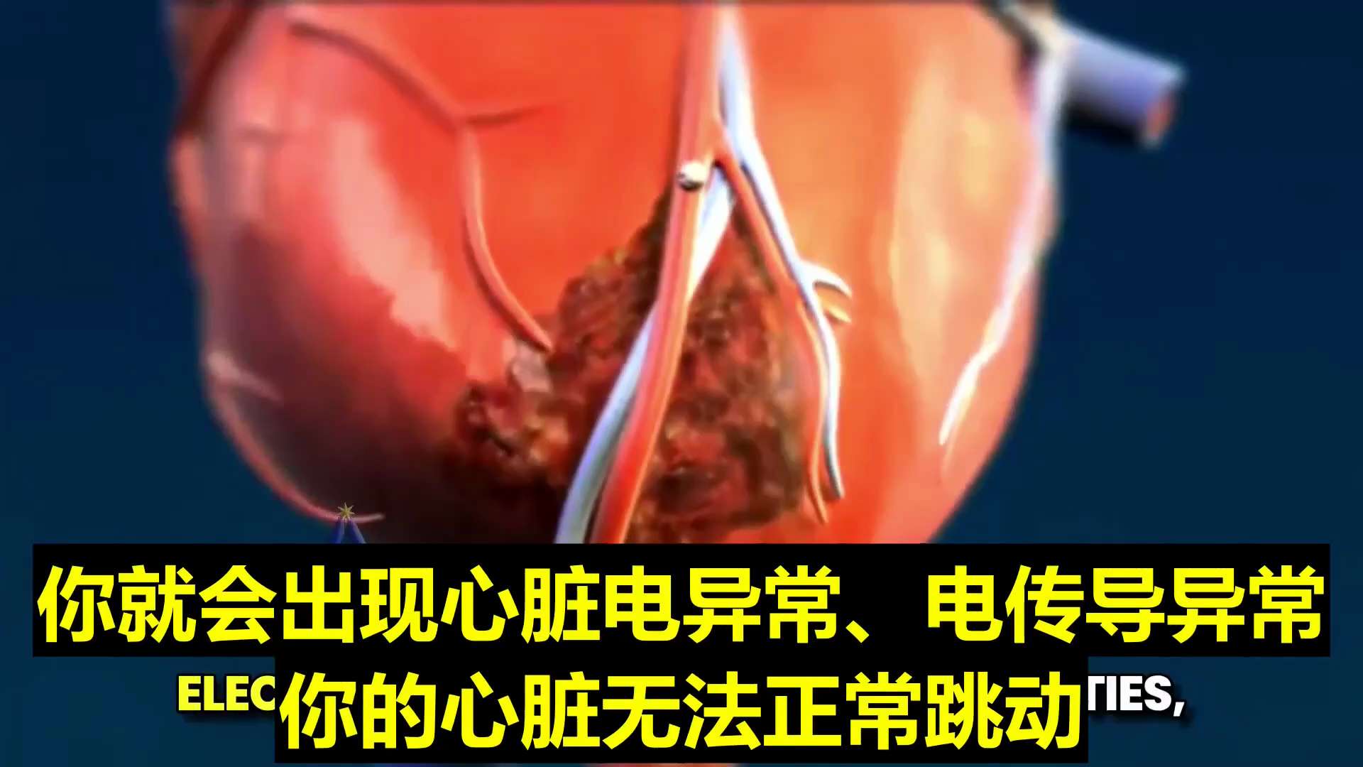 尼克拉·胡尔舍-  新冠疫苗包裹mRNA的脂质纳米颗粒进入心脏后，你的心肌细胞开始产生一种有毒的、非人类的蛋白质(刺突蛋白)，而你的免疫系统会攻击心脏，导致炎症和心脏瘢痕。一旦形成这些瘢痕，你就会出现...