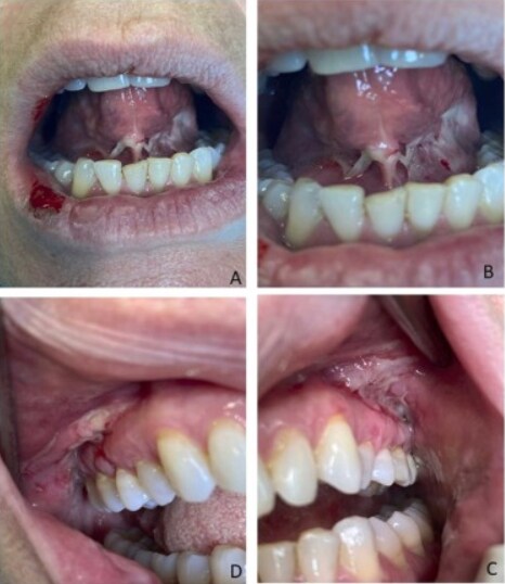 Autoimmune mucocutaneous blistering diseases after SARS-Cov-2 vaccination: A Case report of Pemphigus Vulgaris and a literature review

"To describe a report of oropharyngeal Pemphigus Vulgaris (OPV) triggered by the mRNABNT162b2 vaccine (Comirnaty®/ Pfizer/ BioNTech) and to analyze the clinical and immunological characteristics of the AIBDs cases reported following the SARS-CoV-2 vaccination."

https://www.sciencedirect.com/science/article/pii/S0344033822000772?via%3Dihub

#Pfizer #mRNA @DrNaomiRWolf @mercola @DrEddyMD @DailyExposeGB @EpochTimes @LifeSiteNews