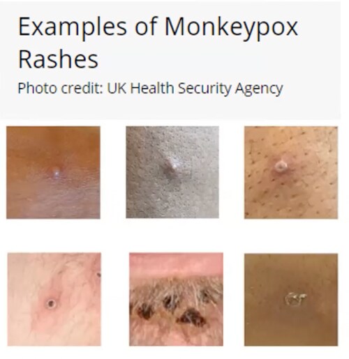 For those who have seen my Monkeypox fear porn slides and substack publications.  Particularly the Jake Tapper/CNN "rebranded" smallpox as monkeypox images.

This is what monkeypox actually looks like.