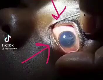 🚨💉😱!!
ファイザーワクチン接種後に見られた症状って😱!!!!
ワクチンの毒性に寄生虫が暴れだしたってこと??
それも黒目しばりで!?