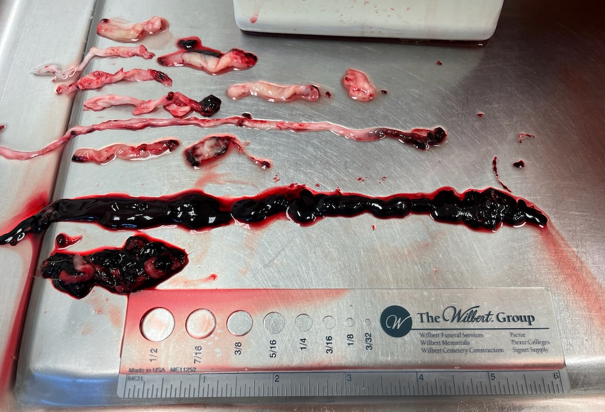 These are clots that an Indiana embalmer pulled out of dead bodies recently. Again, they have never ...