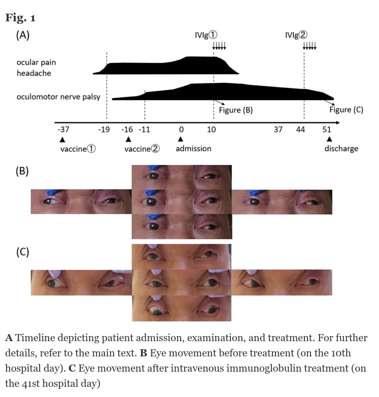 Miller Fisher syndrome following BNT162b2 mRNA coronavirus 2019 vaccination

"We present the case of...