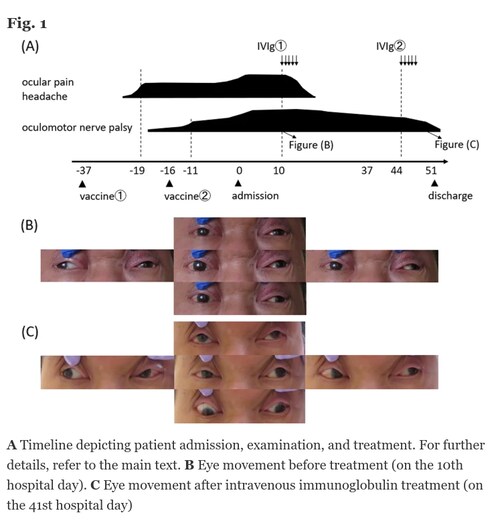 Miller Fisher syndrome following BNT162b2 mRNA coronavirus 2019 vaccination

"We present the case of a 71-year-old man with no history of the SARS-CoV-2 infection or any recent viral or bacterial illnesses who presented with bilateral oculomotor palsy and limb ataxia after BNT162b2 mRNA COVID-19 vaccination."

https://bmcneurol.biomedcentral.com/articles/10.1186/s12883-021-02489-x 

#Pfizer #mRNA #covid19vaccines #MillerFisherSyndrome #GBS @mercola @DrEddyMD @DailyExposeGB @EpochTimes @LifeSiteNews