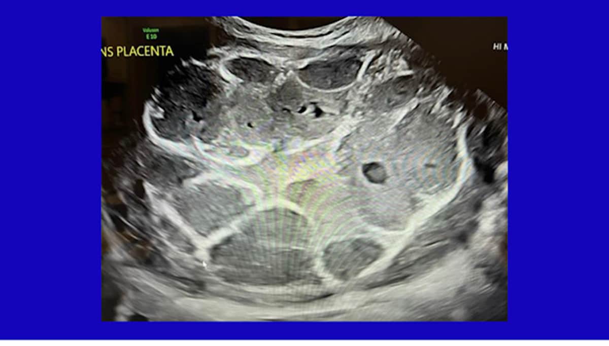 So we see the effects of the vaccine on the placenta compared with a normal uniform grey color found...