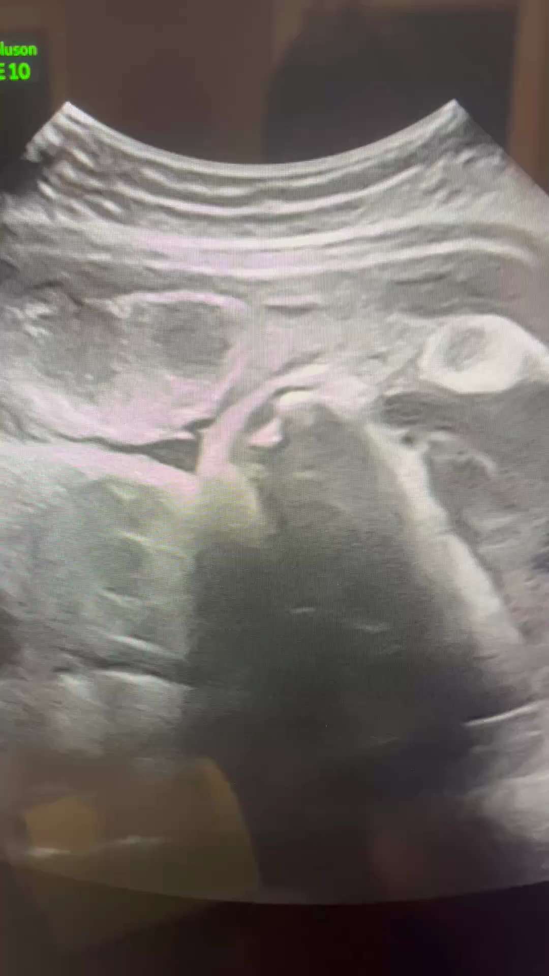 COVID19 Vaccines effects on placentas