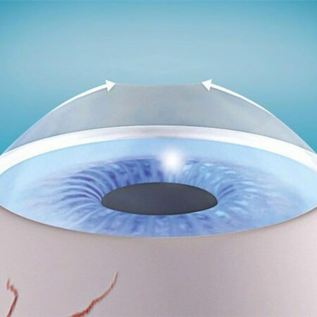 Độ cận thị của mỗi người không giống nhau, vì vậy khó để xác định cận bao nhiêu độ thì mổ được.