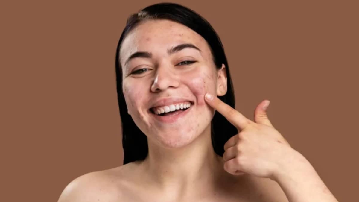 Guide to Safely Popping Blackheads: A Comprehensive Overview

Blackheads are a common skin concern t...