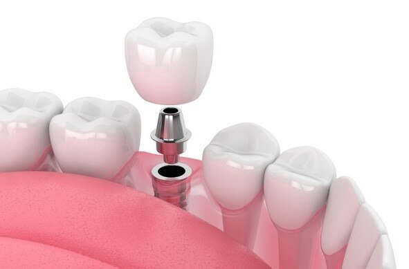 Vai Trò Của Răng Hàm Số 7 – Tại Sao Không Thể Bỏ Qua?
Răng hàm số 7 là một trong những răng hàm chính chịu lực ăn nhai mạnh nhất, đóng vai trò quan trọng trong việc nghiền nhỏ thức ăn. Nếu không có răng này, lực nhai sẽ giảm đi đáng kể, gây áp lực lớn lên các răng còn lại, dẫn đến mất cân đối trong hàm và ảnh hưởng đến tiêu hóa. Đối với thẩm mỹ, răng số 7 tuy không trực tiếp ảnh hưởng đến nụ cười, nhưng việc mất răng này sẽ làm xương hàm bị tiêu biến, gây thay đổi khuôn mặt.
https://nhakhoaparis.vn/trong-rang-so-7-het-bao-nhieu-tien-cap-nhat-bang-gia-chi-tiet.html

