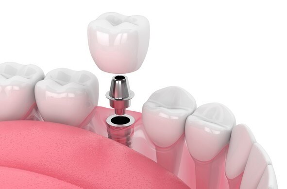 Vai Trò Của Răng Hàm Số 7 – Tại Sao Không Thể Bỏ Qua?
Răng hàm số 7 là một trong những răng hàm chính chịu lực ăn nhai mạnh nhất, đóng vai trò quan trọng t