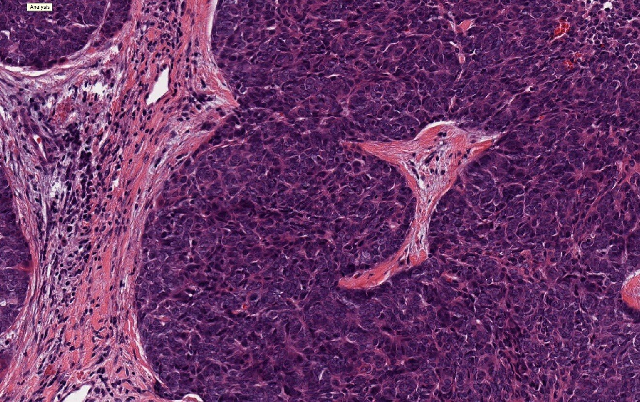 Thymic Carcinoma Drugs Market Is Estimated to Witness High Growth Owing to Immunotherapy Advances


...