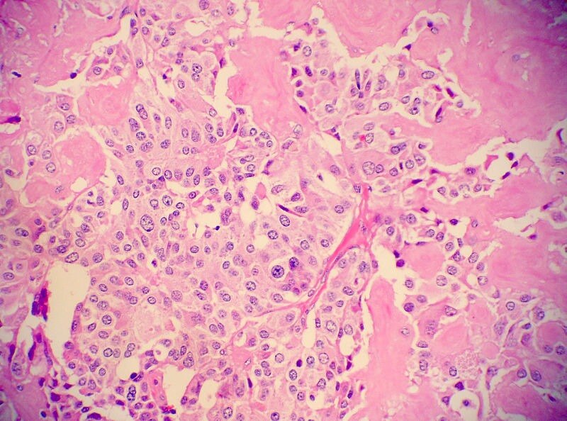 Medullary Thyroid Cancer Drugs Market Poised for Growth with Molecular Targeted Therapies


 The Med...