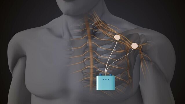 Peripheral Nerve Stimulators Market to Witness High Growth Owing to Wireless Neuromodulation


 Peri...