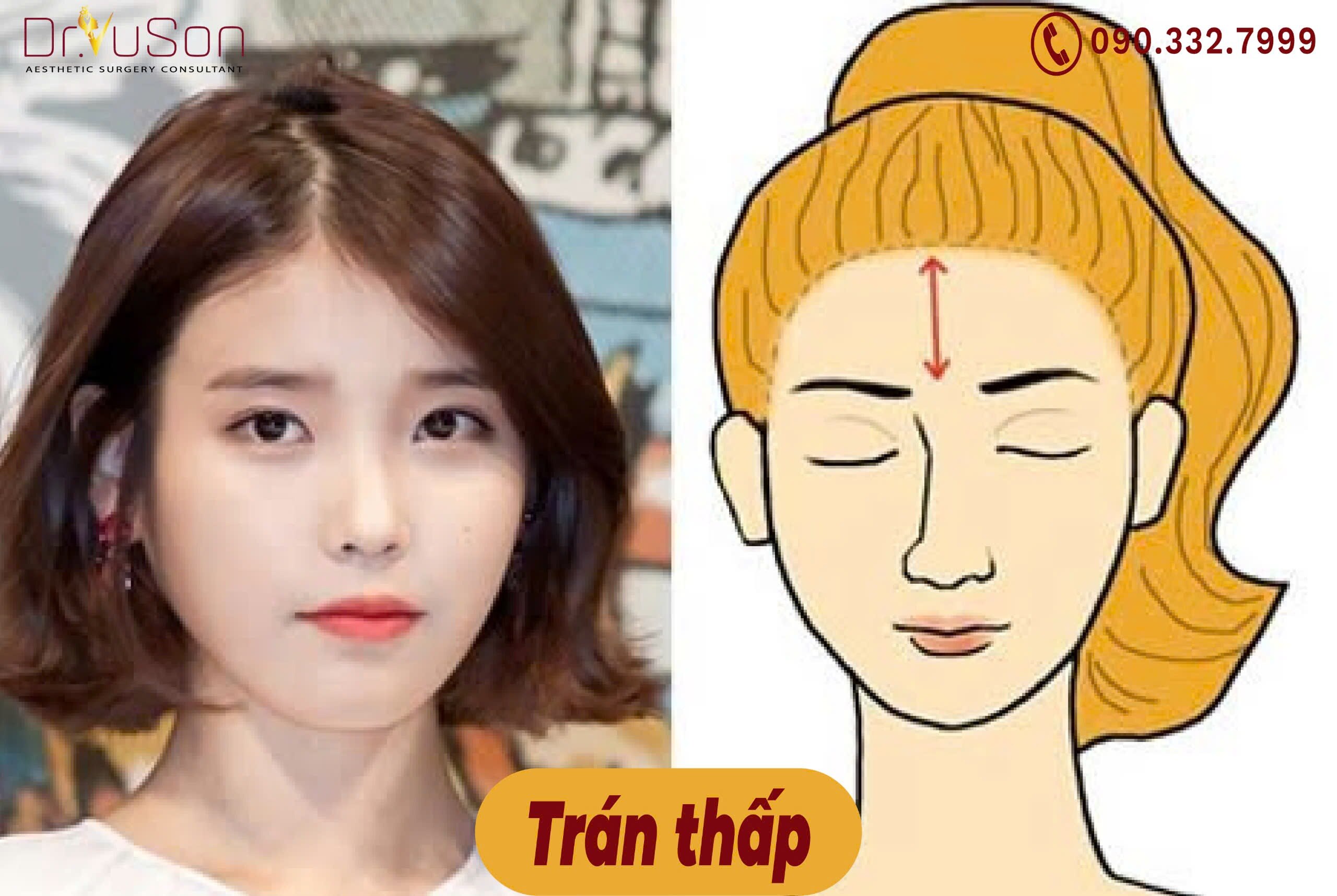 Người trán thấp góc nhìn từ Bác sĩ Vũ Sơn

Người trán thấp từ lâu đã là đặc điểm ngoại hình khiến nh...