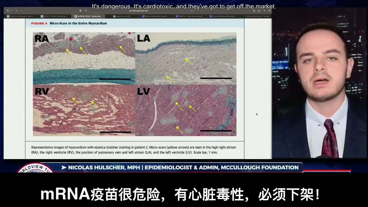 打了五针新冠mRNA加强针后，心脏到底是什么样子？
（首次发现了这个现象，已经打过疫苗的朋友请斟酌观看，避免不适）
