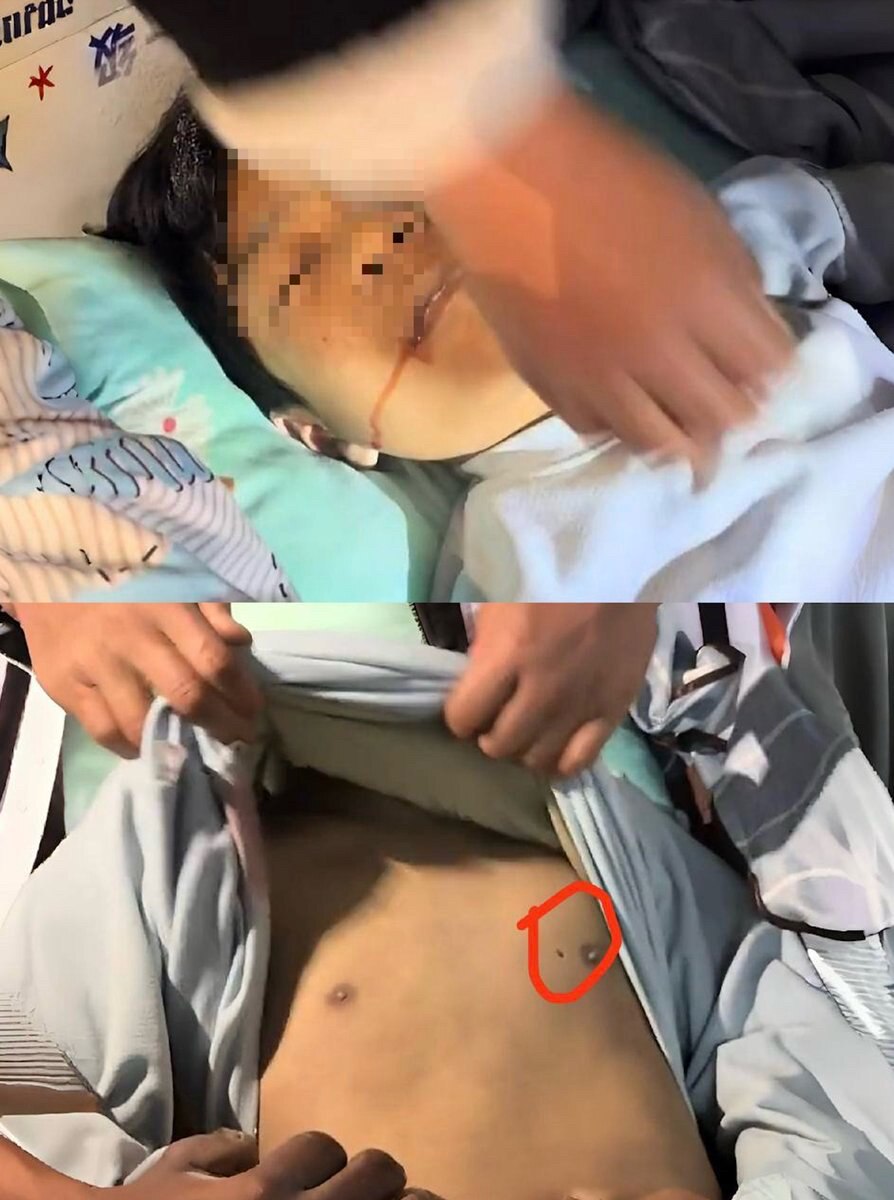 @jackie_9083 这事不简单 说是霸凌 柬埔寨网友留言  这个针孔 叫 拍胸针 专业手法 活摘

学校隔壁就是三甲医院