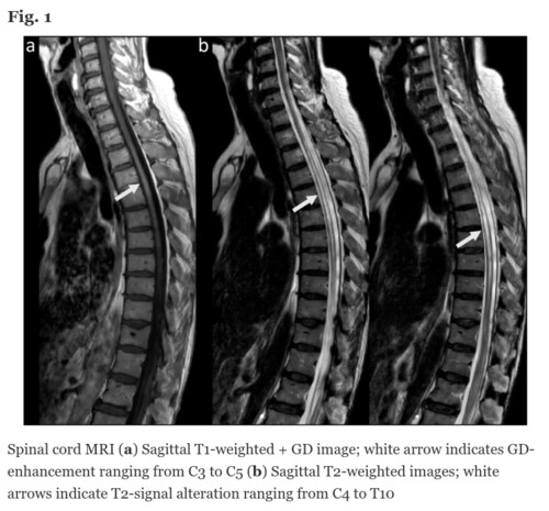 Severe disease exacerbation after mRNA Pfizer-BioNTech COVID-19 vaccination unmasks suspected multiple sclerosis as neuromyelitis optica spectrum disorder: a case report

"... cases like this should make aware of rare neurological disorders manifesting after vaccination and potentially contribute to improvement of management of vaccinating patients with inflammatory CNS disorders in the future."

https://bmcneurol.biomedcentral.com/articles/10.1186/s12883-022-02698-y 
 
#Pfizer #mRNA #covid19vaccines #CNSdisorders @mercola @DrEddyMD @DailyExposeGB @EpochTimes @LifeSiteNews @gatewaypundit