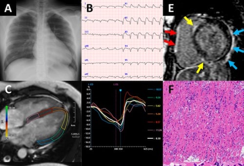 2022:  Biventricular systolic dysfunction in acute myocarditis after SARS-CoV-2 mRNA-1273 vaccination

A 20-year-old woman

https://academic.oup.com/ehjcimaging/article/23/2/e87/6380644

"... careful evaluation of biventricular function should be exercised in individuals presenting with chest pain or dyspnoea after SARS-CoV-2 vaccination."

#Moderna #mRNA #covid19vaccines @DrNaomiRWolf @DrEddyMD @DailyExposeGB @EpochTimes @LifeSiteNews