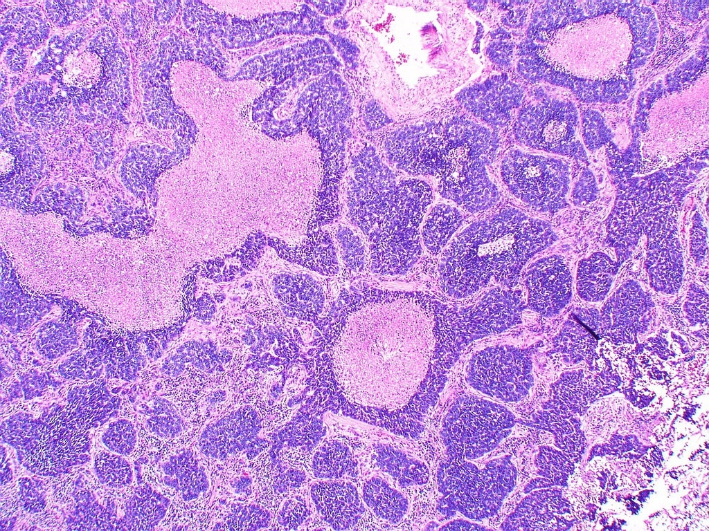 Neuroendocrine Tumors Market is Estimated to Witness High Growth Owing to Rising Prevalence of Neuroendocrine Tumors

Neuroendocrine tumors (NETs) are a group of rare and heterogeneous tumors that originate from neuroendocrine cells throughout the body. These tumors can occur in various organs, including the gastrointestinal tract, pancreas, and lungs.
Neuroendocrine Tumors Market, are known for their ability to secrete hormones and other substances, which can lead to a wide range of symptoms and complications. The diagnosis and treatment of NETs often involve a multidisciplinary approach, utilizing advanced imaging techniques, biomarker testing, and targeted therapies. With the increasing awareness and understanding of NETs, there has been a growing demand for effective diagnostic and therapeutic options.
According to CoherentMI, The Global Neuroendocrine Tumors Market is estimated to be valued at USD 5.11 billion in 2025 and is expected to reach USD 7.89 billion by 2032, growing at a compound annual growth rate (CAGR) of 6.4% from 2025 to 2032.

Key Takeaways

Key players operating in the Neuroendocrine Tumors Market are Novartis AG, Pfizer Inc., Ipsen Pharma, Advanced Accelerator Applications (a Novartis company), and Hutchison MediPharma Limited. These companies are actively involved in the development and commercialization of novel diagnostics and therapeutics for NETs, driving innovation and market growth.

The Neuroendocrine Tumors Market presents significant opportunities for growth and innovation. One of the key opportunities lies in the development of targeted therapies that can effectively treat specific subtypes of NETs. Additionally, there is a growing focus on personalized medicine approaches, which involve tailoring treatment strategies based on the molecular characteristics of individual tumors. The increasing use of biomarkers and companion diagnostics is expected to enhance the precision and effectiveness of NET management.

The Neuroendocrine Tumors Market is witnessing global expansion, with increasing incidence and prevalence rates of NETs worldwide. North America and Europe currently dominate the market, driven by factors such as high healthcare expenditure, advanced healthcare infrastructure, and growing awareness about NETs. However, the Asia-Pacific region is expected to experience the highest growth rate during the forecast period, owing to the rising prevalence of NETs, improving healthcare facilities, and increasing adoption of advanced diagnostic and therapeutic technologies in countries such as China and Japan.

Market Drivers

The rising prevalence of neuroendocrine tumors is a key driver of the Neuroendocrine Tumors Market. The incidence of NETs has been steadily increasing over the past few decades, partly due to improved diagnostic techniques and increased awareness among healthcare professionals. Additionally, factors such as genetic predisposition, environmental exposures, and lifestyle changes may contribute to the development of NETs. As the prevalence of NETs continues to rise, there is a growing need for effective diagnostic and therapeutic options, which is expected to fuel the growth of the Neuroendocrine Tumors Market in the coming years.

PEST Analysis

Political:
The political landscape for neuroendocrine tumor treatment is influenced by government regulations, healthcare policies, and funding for cancer research. Governments across the globe are focusing on improving cancer care and increasing access to advanced treatments, which positively impacts the neuroendocrine tumor market.

Economic:
Economic factors such as healthcare expenditure, insurance coverage, and reimbursement policies play a crucial role in the neuroendocrine tumor market. The availability of funding for research and development, as well as the cost of treatments, can significantly influence market growth.

Social:
Social factors, including increasing awareness about neuroendocrine tumors, changing lifestyles, and an aging population, are driving the demand for effective treatments. As more people become aware of the symptoms and seek medical attention, the market for neuroendocrine tumor treatments is expected to grow.

Technological:
Technological advancements in diagnostic techniques, such as imaging and biomarker testing, are enabling early detection and accurate staging of neuroendocrine tumors. Furthermore, the development of targeted therapies and personalized medicine approaches is improving treatment outcomes and driving market growth.

Geographical Regions:
The neuroendocrine tumor market, in terms of value, is primarily concentrated in North America and Europe. These regions have well-established healthcare infrastructure, high healthcare expenditure, and a growing prevalence of neuroendocrine tumors. The United States is the largest market for neuroendocrine tumor treatments, driven by factors such as advanced diagnostic capabilities, a large patient population, and favorable reimbursement policies. Europe, particularly countries like Germany, France, and the United Kingdom, also holds a significant share of the market due to increasing awareness, robust healthcare systems, and a focus on research and development.

Fastest Growing Region:
The Asia-Pacific region is expected to be the fastest-growing market for neuroendocrine tumor treatments in the coming years. Countries such as China, Japan, and India are witnessing rapid economic growth, improving healthcare infrastructure, and increasing healthcare expenditure. The large patient population, coupled with rising awareness about neuroendocrine tumors and the availability of advanced treatments, is driving market growth in this region. Moreover, the presence of a skilled workforce and lower manufacturing costs in countries like India and China are attracting global players to expand their presence in the Asia-Pacific market. As healthcare access improves and disposable incomes rise, the demand for neuroendocrine tumor treatments is expected to surge in this region.

Get this Report in Japanese Language: 神経内分泌腫瘍市場

Get this Report in Korean Language: 신경내분비종양시장

About Author:
Ravina Pandya, Content Writer, has a strong foothold in the market research industry. She specializes in writing well-researched articles from different industries, including food and beverages, information and technology, healthcare, chemical and materials, etc. (https://www.linkedin.com/in/ravina-pandya-1a3984191)
