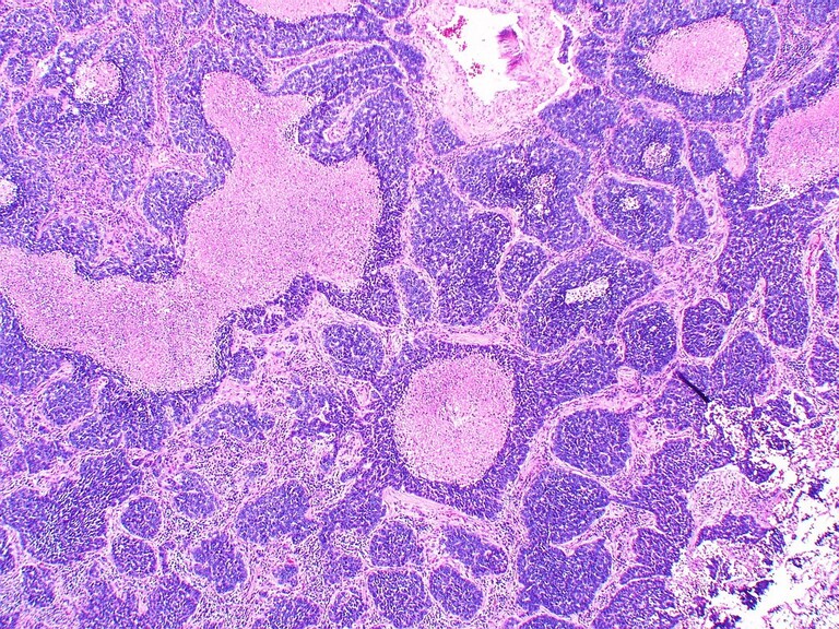 Neuroendocrine Tumors Market is Estimated to Witness High Growth Owing to Rising Prevalence of Neuroendocrine Tumors

Neuroendocrine tumors (NETs) are a gr