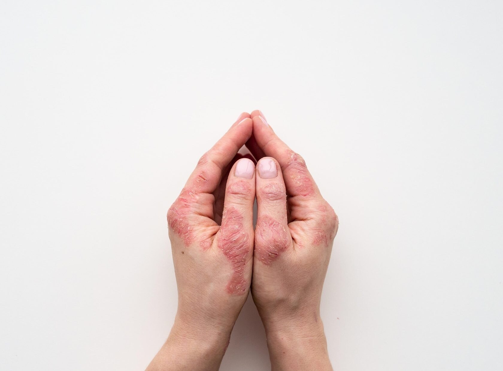 Plaque Psoriasis Market is Estimated to Witness High Growth Owing to Biologics

The plaque psoriasis...