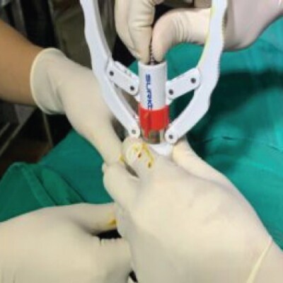 Cắt bao quy đầu không chỉ là một giải pháp y tế cần thiết trong một số trường hợp dài, hẹp, nghẹt hay viêm bao quy đầu.
