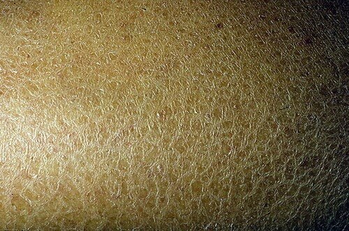 Lamellar Ichthyosis Market Set to Surge with Gene Therapy



The Lamellar Ichthyosis Market encompas...